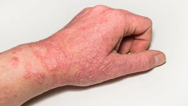 Red Light Therapy for Eczema | Skin Inflammation, Itch & Recovery Support