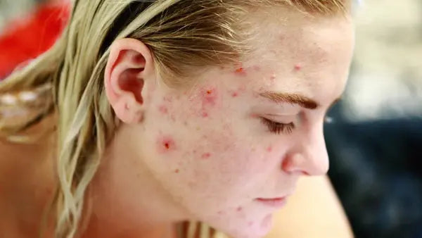 Red Light Therapy for Acne: How It Works, What to Expect and Red vs. Blue Light