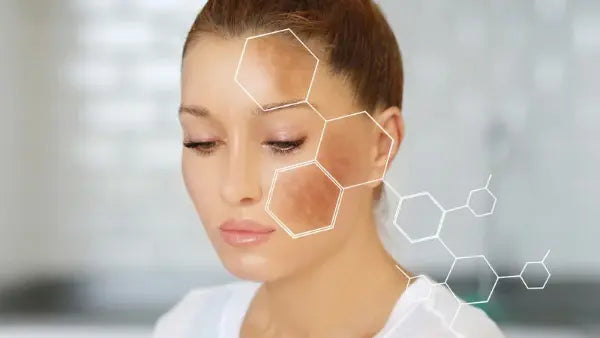 Red light therapy for melasma and hyperpigmentation