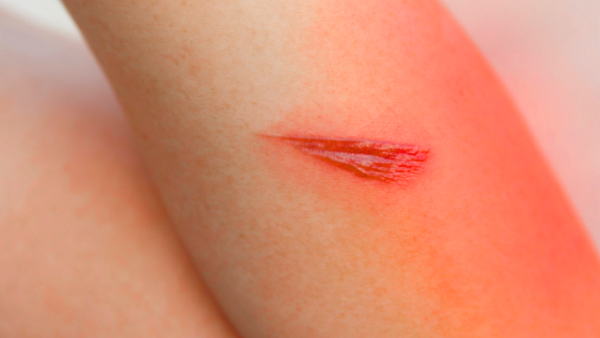 close-up shot of a wound with a red light glow