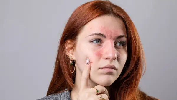 Red Light Therapy for Rosacea | How It Works & What to Expect