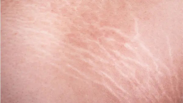 Red Light Therapy for Stretch Marks | How It Works & What to Expect